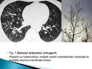  Fig. 7 Semnul arborelui inmugurit.
Pacient cu tuberculoza: multipli noduli centrilobulari conectati la
multiple structuri ramificate liniare
 