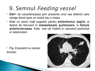  Def= se caracterizeaza prin prezenta unui vas distinct care
merge direct spre un nodul sau o masa
 Este un semn inalt sugestiv pentru embolismul septic si
destul de frecvent in metastazele pulmonare si fistula
arteriovenoasa. Este mai rar intalnit in cancerul pulmonar
si tuberculom.
 Fig. 8 pacient cu cancer
bronsic
 