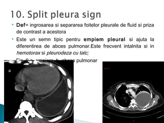  Def= ingrosarea si separarea foitelor pleurale de fluid si priza
de contrast a acestora
 Este un semn tipic pentru empiem pleural si ajuta la
diferentirea de abces pulmonar.Este frecvent intalnita si in
hemotorax si pleurodeza cu talc;
Fig. 9 a. empiem, b. abces pulmonar
a
b
 