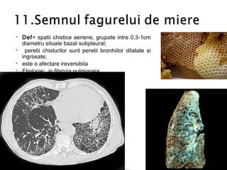  Def= spatii chistice aeriene, grupate intre 0,3-1cm
diametru situate bazal subpleural;
 peretii chisturilor sunt peretii bronhiilor dilatate si
ingrosate;
 este o afectare ireversibila
 Etiologie: in fibroza pulmonara
 