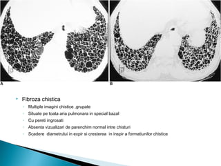  Fibroza chistica
◦ Multiple imagini chistice ,grupate
◦ Situate pe toata aria pulmonara in special bazal
◦ Cu pereti ingrosati
◦ Absenta vizualizari de parenchim normal intre chisturi
◦ Scadere diametrului in expir si cresterea in inspir a formatiunilor chistice
 