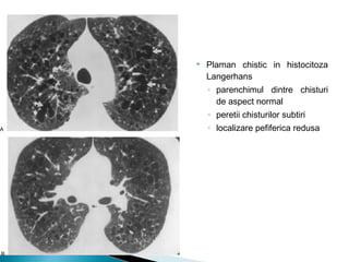  Plaman chistic in histocitoza
Langerhans
◦ parenchimul dintre chisturi
de aspect normal
◦ peretii chisturilor subtiri
◦ localizare pefiferica redusa
 