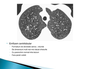  Emfizem centrilobular
◦ Formatiuni de densitate aerica , rotunde
◦ De dimensiuni mult mai mici decat chisturile
◦ Cu parenchim normal intre leziuni
◦ Fara pereti vizibili
 