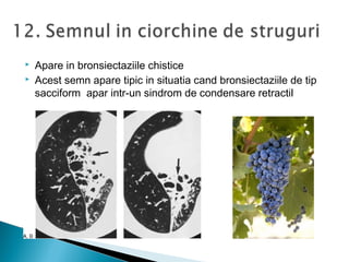  Apare in bronsiectaziile chistice
 Acest semn apare tipic in situatia cand bronsiectaziile de tip
sacciform apar intr-un sindrom de condensare retractil
 