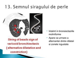  Intalnit in bronsiectaziile
moliniforme
 Apare ca urmare a
alternantei dintre dilataii
si zonele ingustate
 