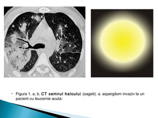  Figura 1. a, b. CT semnul haloului (sageti). a. aspergilom invaziv la un
pacient cu leucemie acuta:
a
 