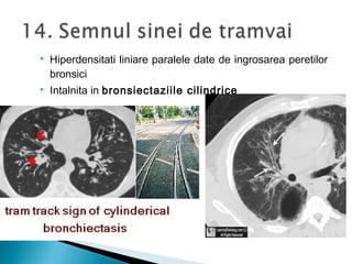  Hiperdensitati liniare paralele date de ingrosarea peretilor
bronsici
 Intalnita in bronsiectaziile cilindrice
 