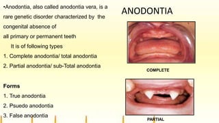 ANODONTIA
•Anodontia, also called anodontia vera, is a
rare genetic disorder characterized by the
congenital absence of
all primary or permanent teeth
It is of following types
1. Complete anodontia/ total anodontia
2. Partial anodontia/ sub-Total anodontia
Forms
1. True anodontia
2. Psuedo anodontia
3. False anodontia
COMPLETE
PARTIAL
 
