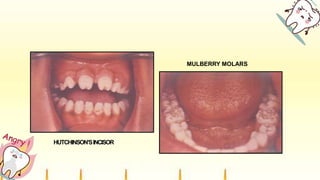 HUTCHINSON’SINCISOR
MULBERRY MOLARS
 