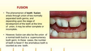 FUSION
• The phenomenon of tooth fusion
arises through union of two normally
separated tooth germs, and
depending upon the stage of
development of the teeth at the time
of union, it may be either complete or
incomplete.
• However, fusion can also be the union of
a normal tooth bud to a supernumerary
tooth germ. In these cases, the number
of teeth is fewer if the anomalous tooth is
counted as one tooth.
 