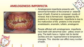 AMELOGENESIS IMPERFECTA
• Amelogenesis imperfecta presents with
abnormal formation of the enamel or external
layer of teeth. Enamel is composed mostly of
mineral, that is formed and regulated by the
proteins in it. Amelogenesis imperfecta is due to
the malfunction of the proteins in the enamel:
ameloblastin, enamelin, tuftelin, amelogenin
• People afflicted with amelogenesis imperfecta
have teeth with abnormal color: yellow, brown or
grey. The teeth have a higher risk for dental
cavities and are hypersensitive to temperature
changes. This disorder can afflict many number
of teeth.
 
