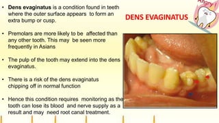 DENS EVAGINATUS
• Dens evaginatus is a condition found in teeth
where the outer surface appears to form an
extra bump or cusp.
• Premolars are more likely to be affected than
any other tooth. This may be seen more
frequently in Asians
• The pulp of the tooth may extend into the dens
evaginatus.
• There is a risk of the dens evaginatus
chipping off in normal function
• Hence this condition requires monitoring as the
tooth can lose its blood and nerve supply as a
result and may need root canal treatment.
 