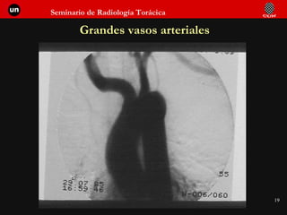 Grandes vasos arteriales 