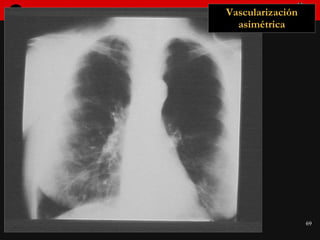 Vascularización asimétrica 