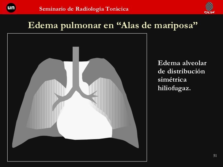 Radiología del tórax 1