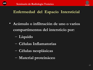 Enfermedad  del  Espacio  Intersticial Acúmulo o infiltración de uno o varios compartimentos del intersticio por: Líquido Células Inflamatorias Células neoplásicas Material proteináceo 