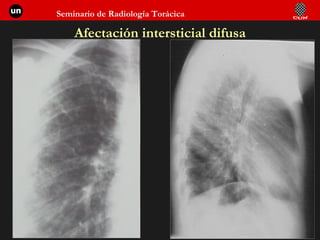 Afectación intersticial difusa 