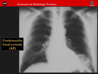 Condensación basal cavitada (AP) 