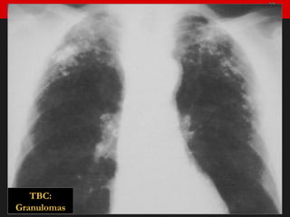TBC: Granulomas 