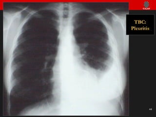 TBC: Pleuritis 