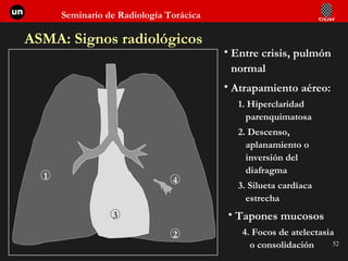 ASMA: Signos radiológicos Entre crisis, pulmón normal Atrapamiento aéreo:  1. Hiperclaridad parenquimatosa 2. Descenso, aplanamiento o inversión del diafragma 3. Silueta cardíaca estrecha Tapones mucosos 4. Focos de atelectasia o consolidación 1 2 3 4 