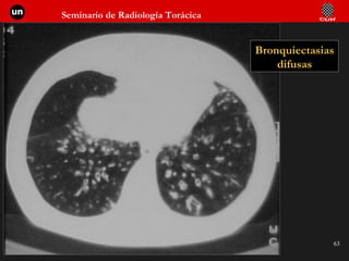 Bronquiectasias difusas 