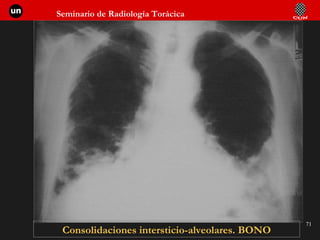 Consolidaciones intersticio-alveolares. BONO 