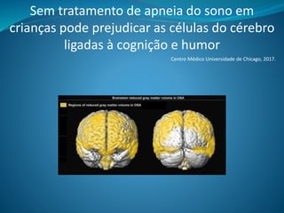 Sem tratamento de apneia do sono em
crianças pode prejudicar as células do cérebro
ligadas à cognição e humor
Centro Médico Universidade de Chicago, 2017.
 