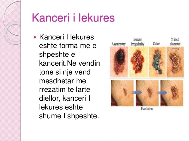 Semundjet Kanceri Semundjet Kanceri