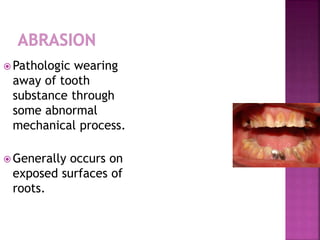 Pathologic wearing 
away of tooth 
substance through 
some abnormal 
mechanical process. 
Generally occurs on 
exposed surfaces of 
roots. 
 