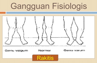 Orang Rakitis Sendi, otot, & kelainan | PPTX