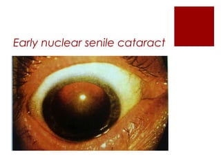 Early nuclear senile cataract
 