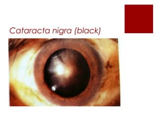 Cataracta nigra (black)
 