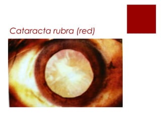 Cataracta rubra (red)
 