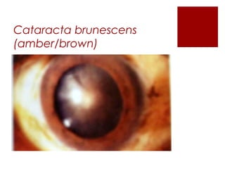 immature senile cataract iris shadow Images High... Immature Senile Cataract