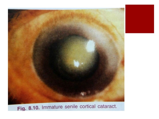 cortical cataract