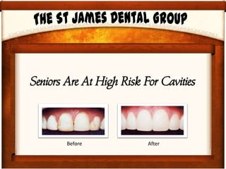 Seniors Are At High Risk For Cavities
Before After
 