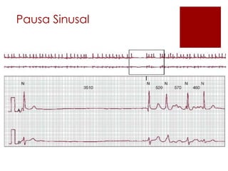 Pausa Sinusal

 