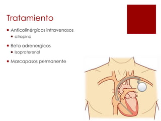 Tratamiento
 Anticolinérgicos intravenosos
 atropina

 Beta adrenergicos
 Isoproterenol

 Marcapasos permanente

 