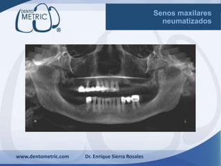 www.dentometric.com Dr. Enrique Sierra Rosales
Senos maxilares
neumatizados
 