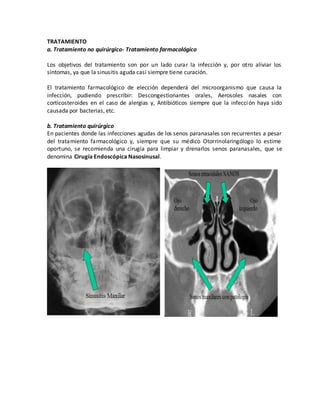 TRATAMIENTO
a. Tratamiento no quirúrgico- Tratamiento farmacológico
Los objetivos del tratamiento son por un lado curar la infección y, por otro aliviar los
síntomas, ya que la sinusitis aguda casi siempre tiene curación.
El tratamiento farmacológico de elección dependerá del microorganismo que causa la
infección, pudiendo prescribir: Descongestionantes orales, Aerosoles nasales con
corticosteroides en el caso de alergias y, Antibióticos siempre que la infección haya sido
causada por bacterias, etc.
b. Tratamiento quirúrgico
En pacientes donde las infecciones agudas de los senos paranasales son recurrentes a pesar
del tratamiento farmacológico y, siempre que su médico Otorrinolaringólogo lo estime
oportuno, se recomienda una cirugía para limpiar y drenarlos senos paranasales, que se
denomina Cirugía Endoscópica Nasosinusal.
 