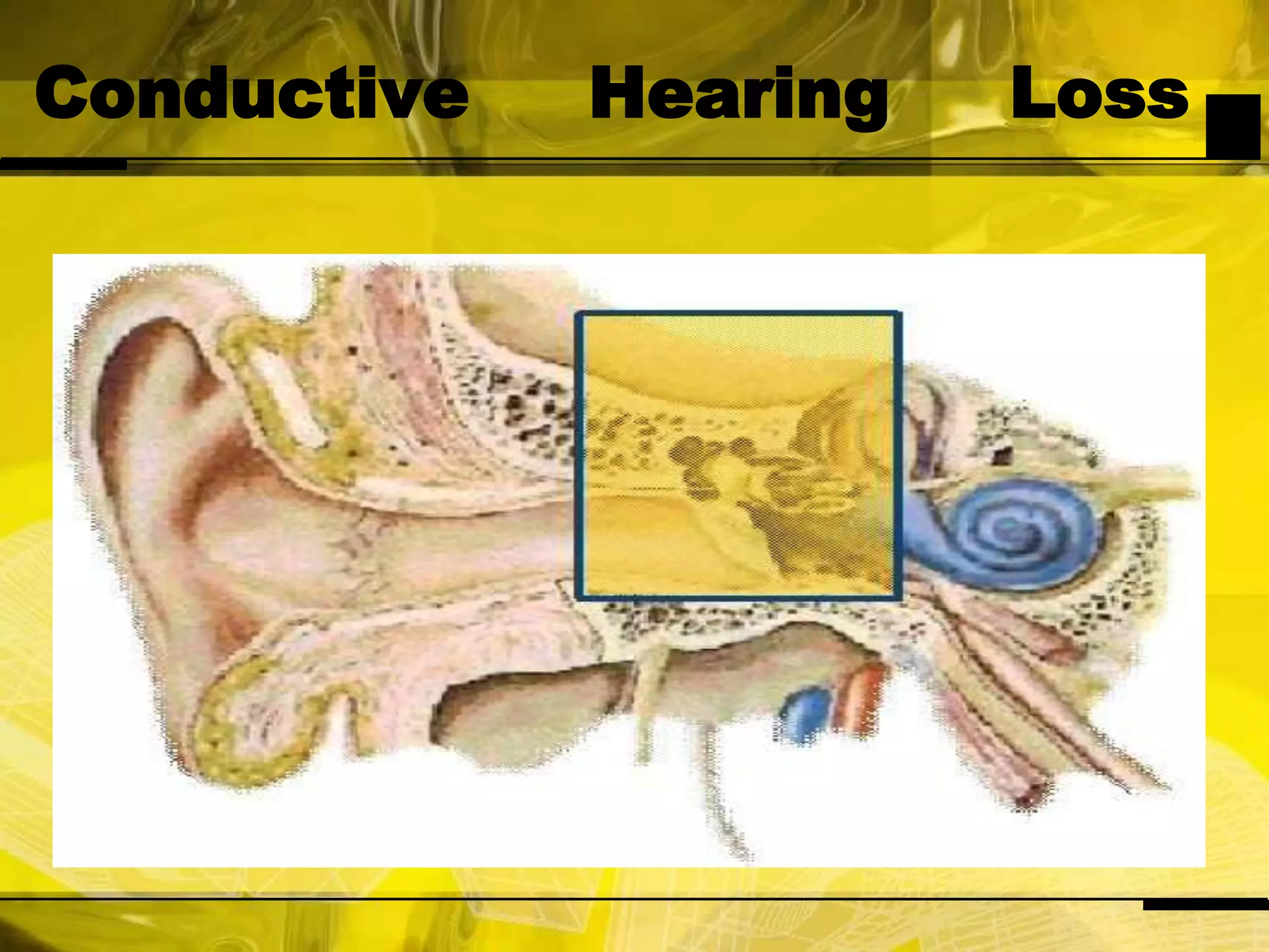 Conductive Hearing Loss