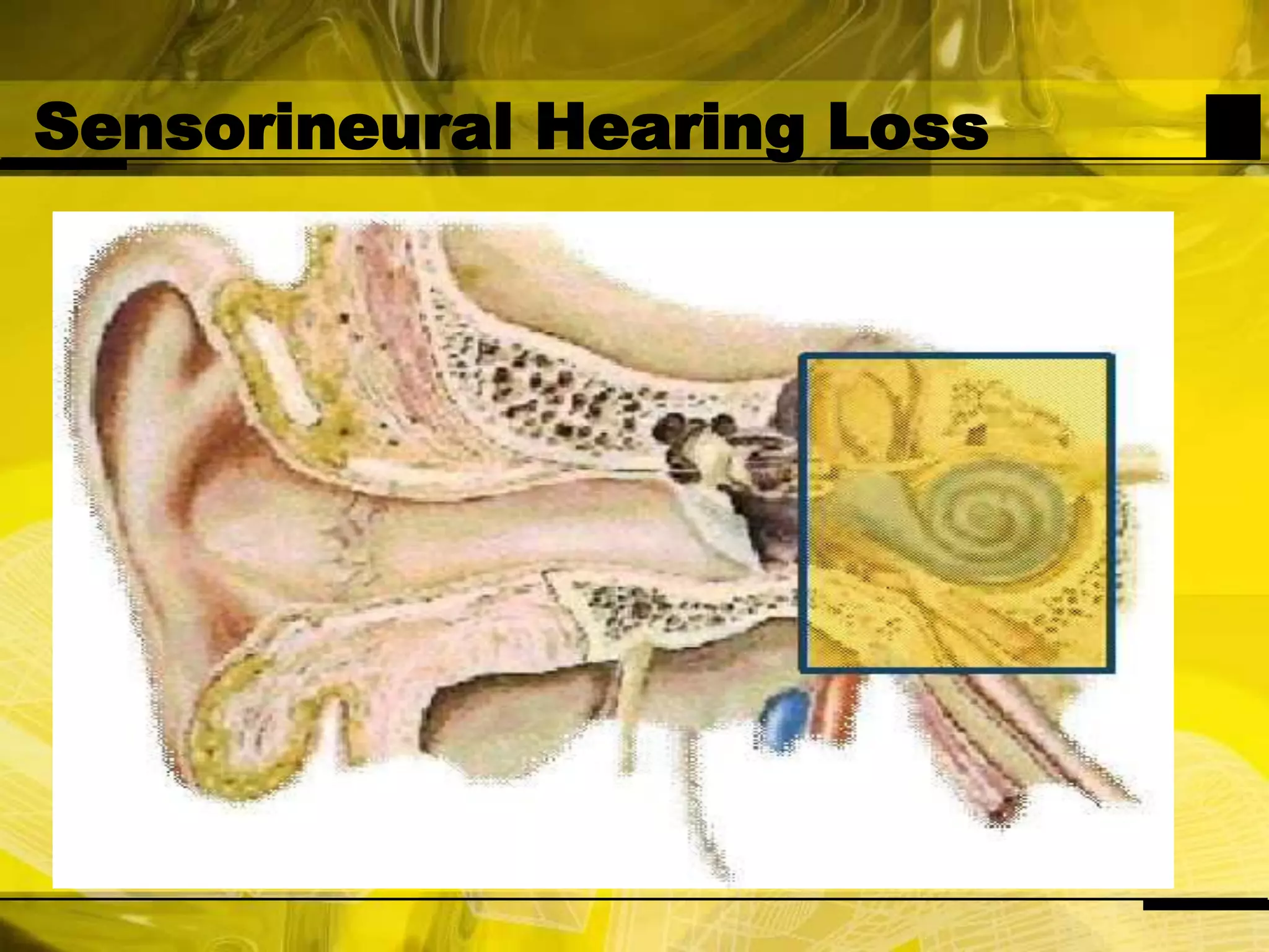 Sensorineural Hearing Loss
