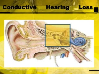 Conductive Hearing Loss
