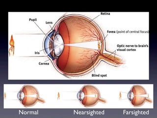 Normal   Nearsighted   Farsighted
 