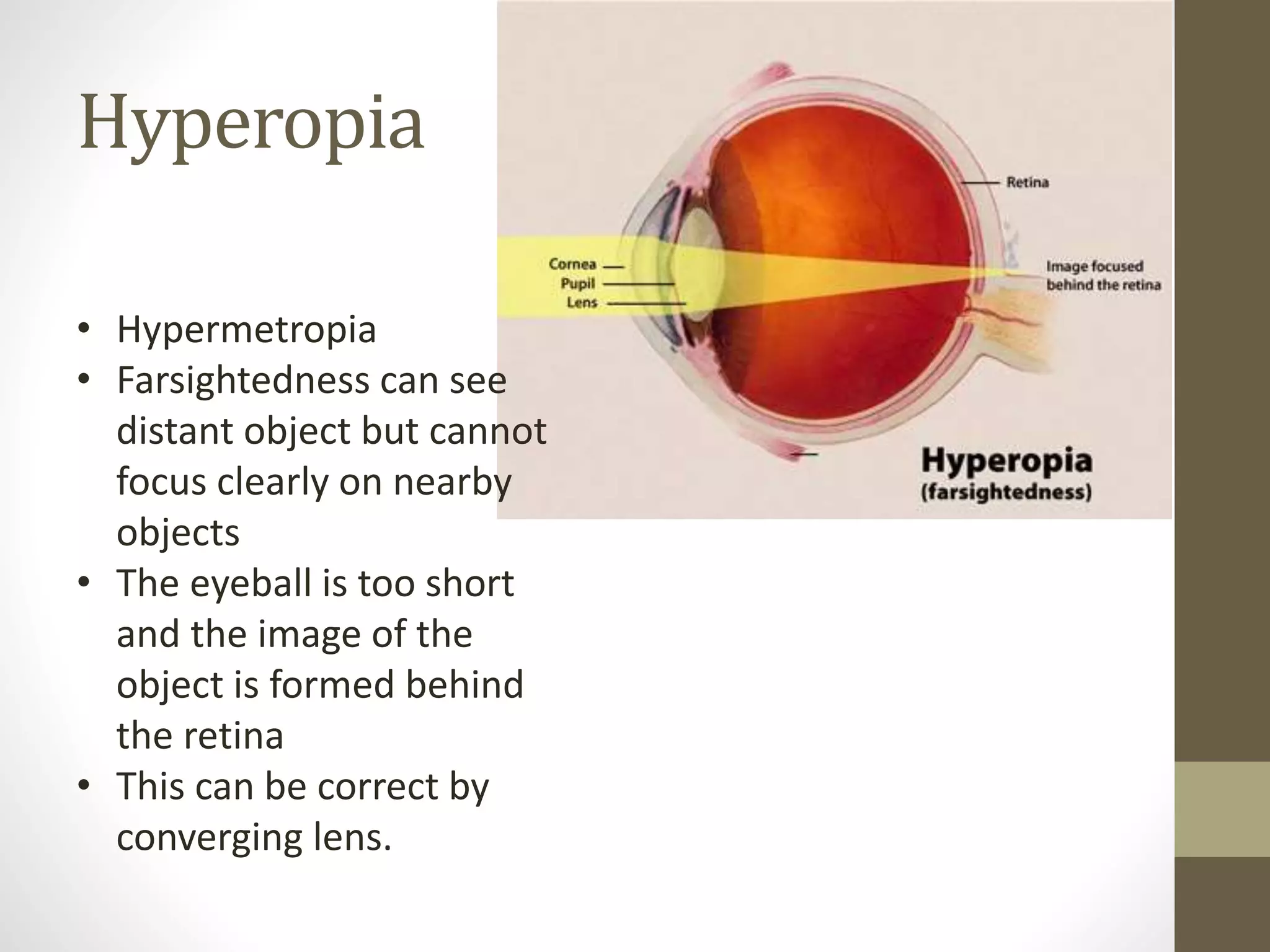 Hyperopia
• Hypermetropia
• Farsightedness can see
distant object but cannot
focus clearly on nearby
objects
• The eyeball is too short
and the image of the
object is formed behind
the retina
• This can be correct by
converging lens.
 