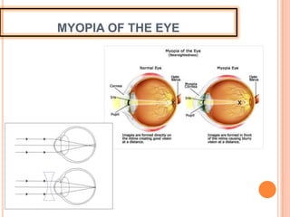 MYOPIA OF THE EYE
 