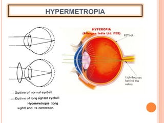 HYPERMETROPIA
 