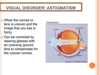 VISUAL DISORDER: ASTIGMATISM
 When the cornea or
lens is uneven and the
image that you see is
fuzzy.
 Can be corrected by
wearing glasses with
an unevenly ground
lens to compensate for
the uneven cornea.
 