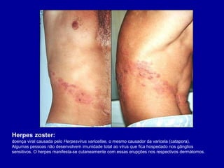 Herpes zoster:
doença viral causada pelo Herpesvirus varicellae, o mesmo causador da varicela (catapora).
Algumas pessoas não desenvolvem imunidade total ao vírus que fica hospedado nos gânglios
sensitivos. O herpes manifesta-se cutaneamente com essas erupções nos respectivos dermátomos.
 